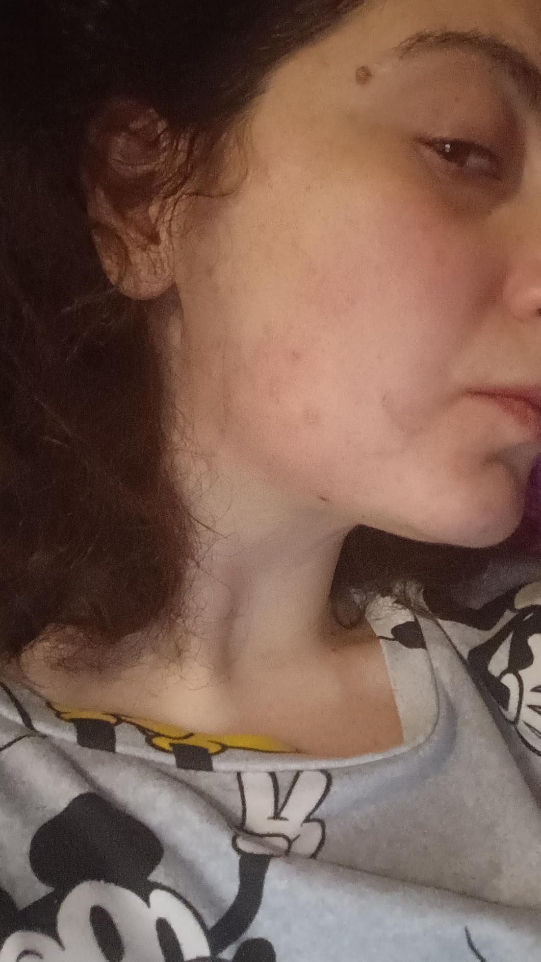 Perfetto con la dermatite